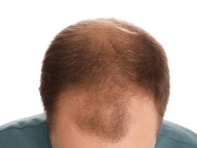Alline Promen : Lutter contre la perte de cheveux chez l’homme
