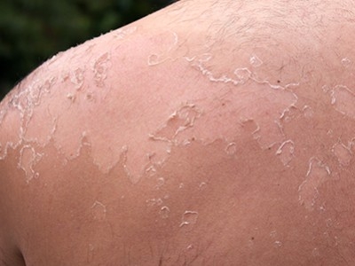 Les brûlures : les reconnaître et savoir quoi faire - Puis-je soigner ma brûlure ?