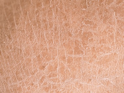 Ma peau est-elle sèche ou déshydratée ?
